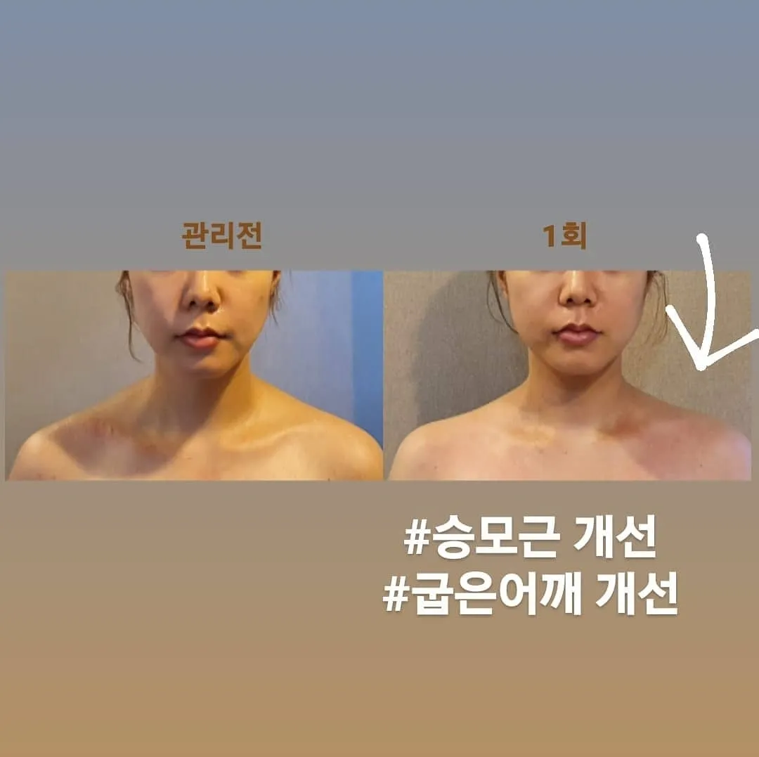 얼굴윤곽관리 전후사진 / 안용자 - 숨고, 숨은고수 얼굴윤곽관리 전후사진