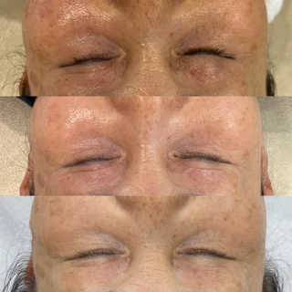 실크테라피 3회 후 피부톤 변화