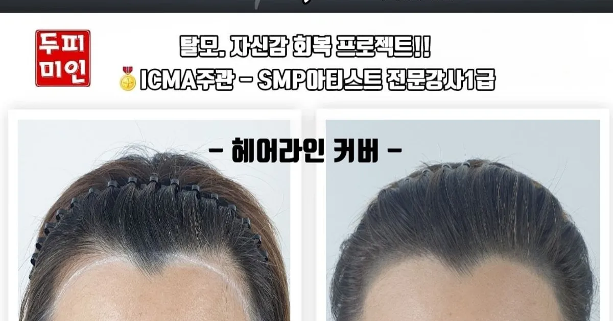 두피smp (탈모커버) / 유미에스테틱 - 숨고, 숨은고수 두피smp (탈모커버)