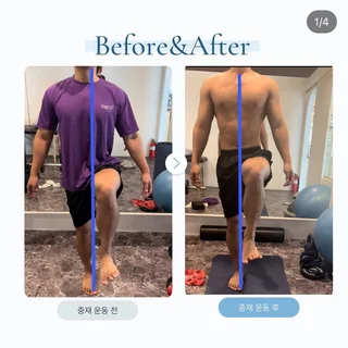 체형교정 및 통증개선, 보행패턴 개선사례