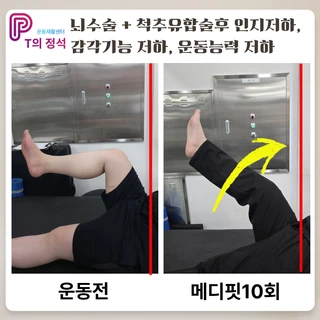 뇌수술·척추유합술 후, 맞춤형 재활 PT로 되찾은 일상과 활력