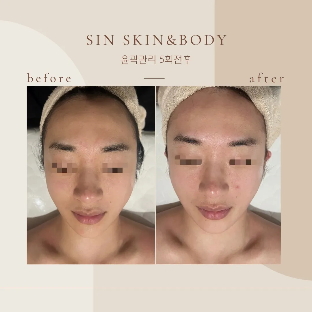 얼굴윤곽관리✨ / 신효림 - 숨고, 숨은고수 얼굴윤곽관리✨