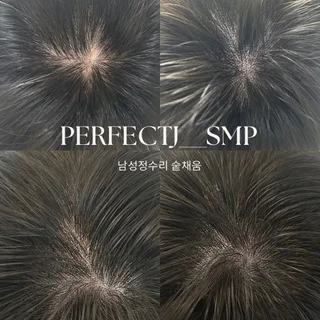 남성 정수리