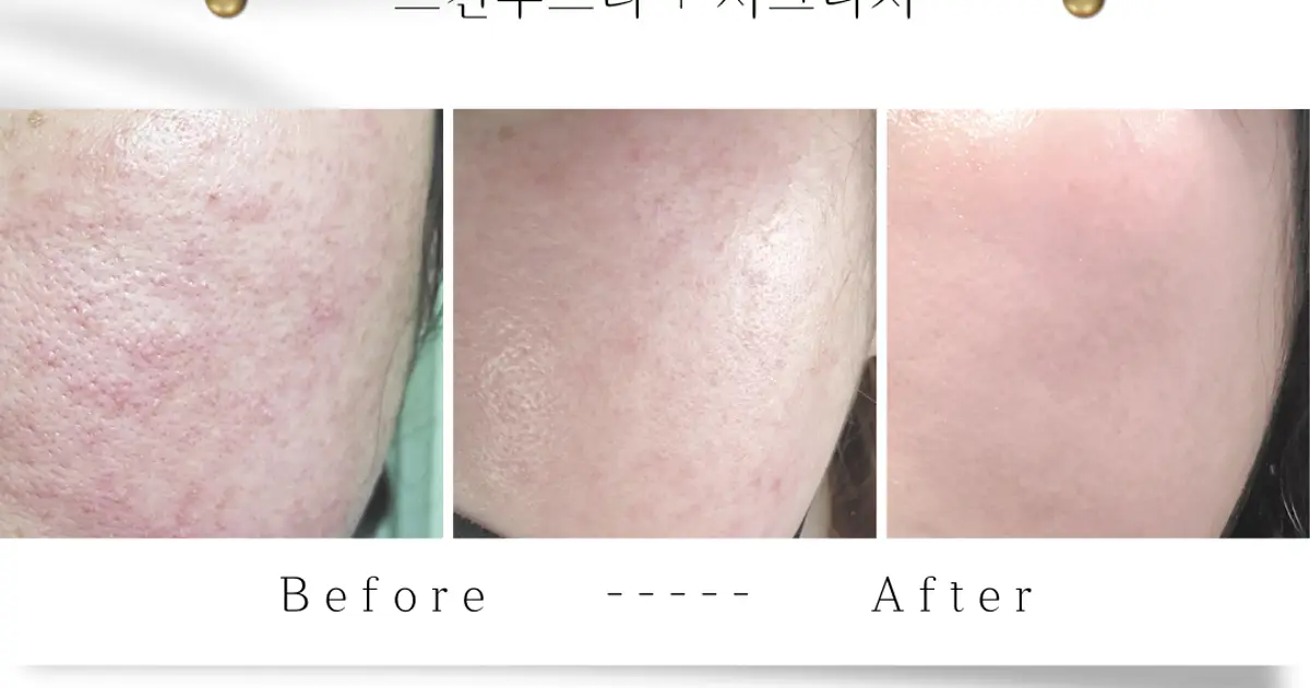 스킨부스터+아라누리 시그니처케어 시너지 / 김누리 - 숨고, 숨은고수 스킨부스터+아라누리 시그니처케어 시너지