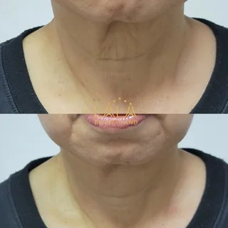 문제성피부.바디멜라닌케어