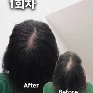 여성 가르마 정수리 커버 2회차 (2/3)