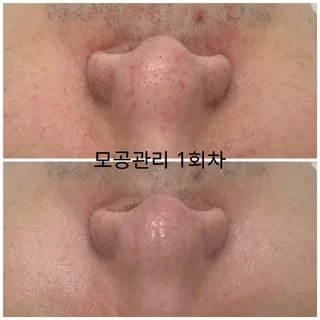 모공디톡스관리