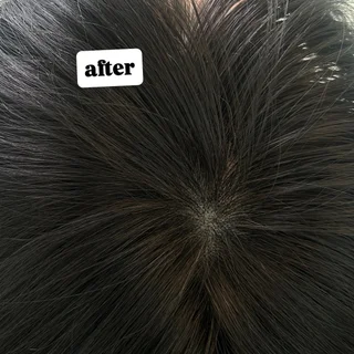 남성 정수리