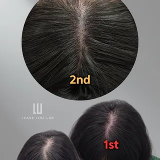 여성 가르마 정수리 커버 2회차 (2/3)