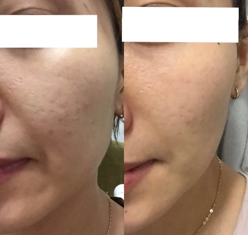 피부/탈모관리 비포 애프터 사진 / 우은혜 - 숨고, 숨은고수 피부/탈모관리 비포 애프터 사진