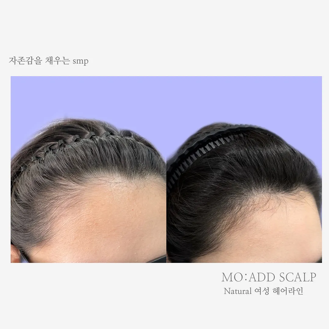 가르마 / 정수리 / 헤어라인 / 흉터커버 / 박지연 - 숨고, 숨은고수 가르마 / 정수리 / 헤어라인 / 흉터커버