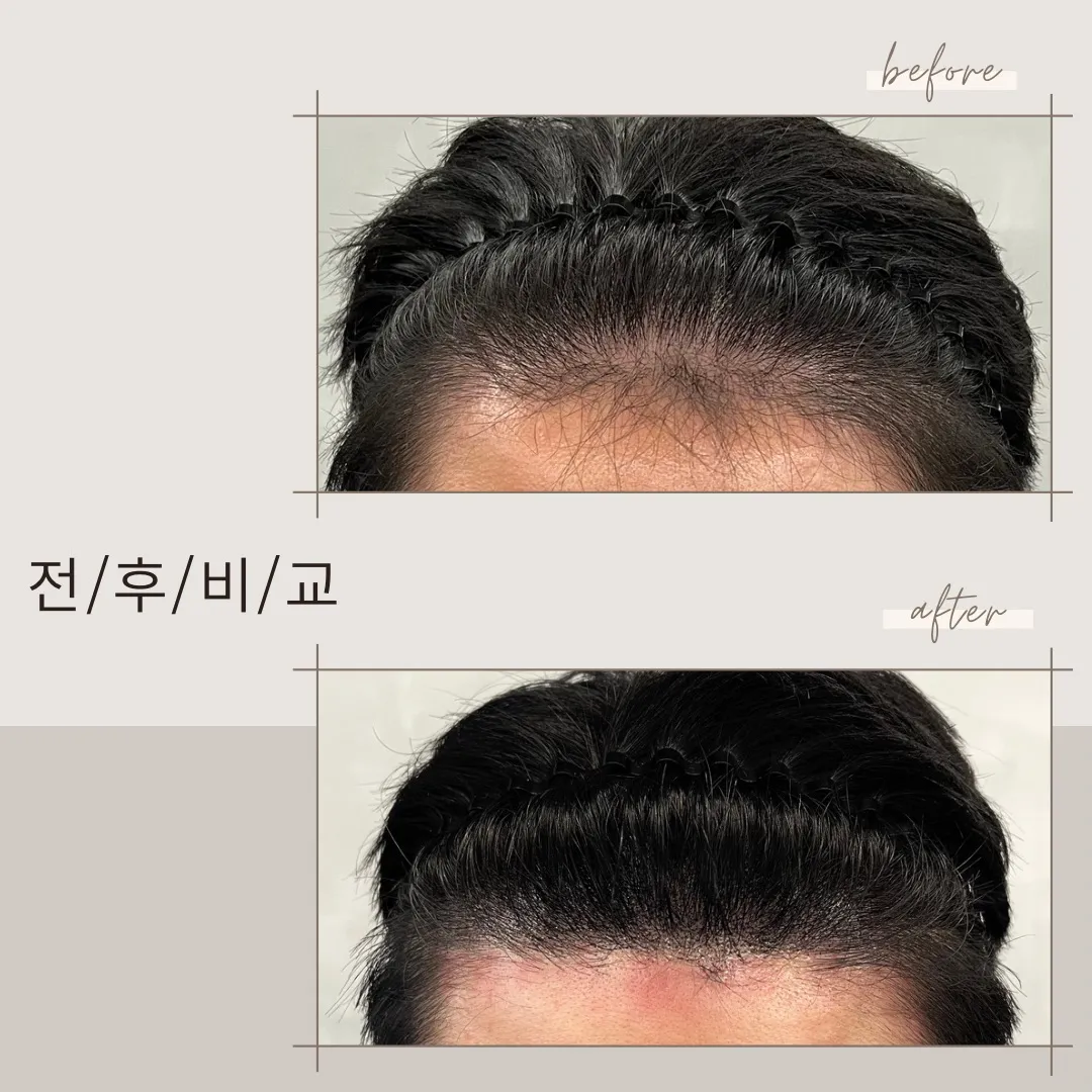 SMP 삭발, 숱채움,헤어라인교정 / 이창준 - 숨고, 숨은고수 SMP 삭발, 숱채움,헤어라인교정