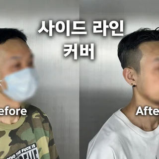 남성 탈모커버 전체 시술 3회차 작업완료 (3/3)
