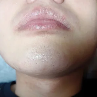 턱수염왁싱
