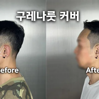 남성 탈모커버 전체 시술 3회차 작업완료 (3/3)