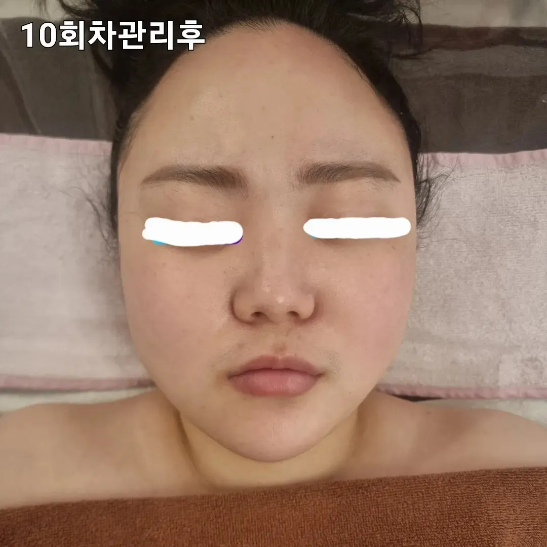 윤곽관리전후 얼굴리프팅 광대축소 / 김정임 - 숨고, 숨은고수 윤곽관리전후 얼굴리프팅 광대축소 / 김정임 - 숨고, 숨은고수
