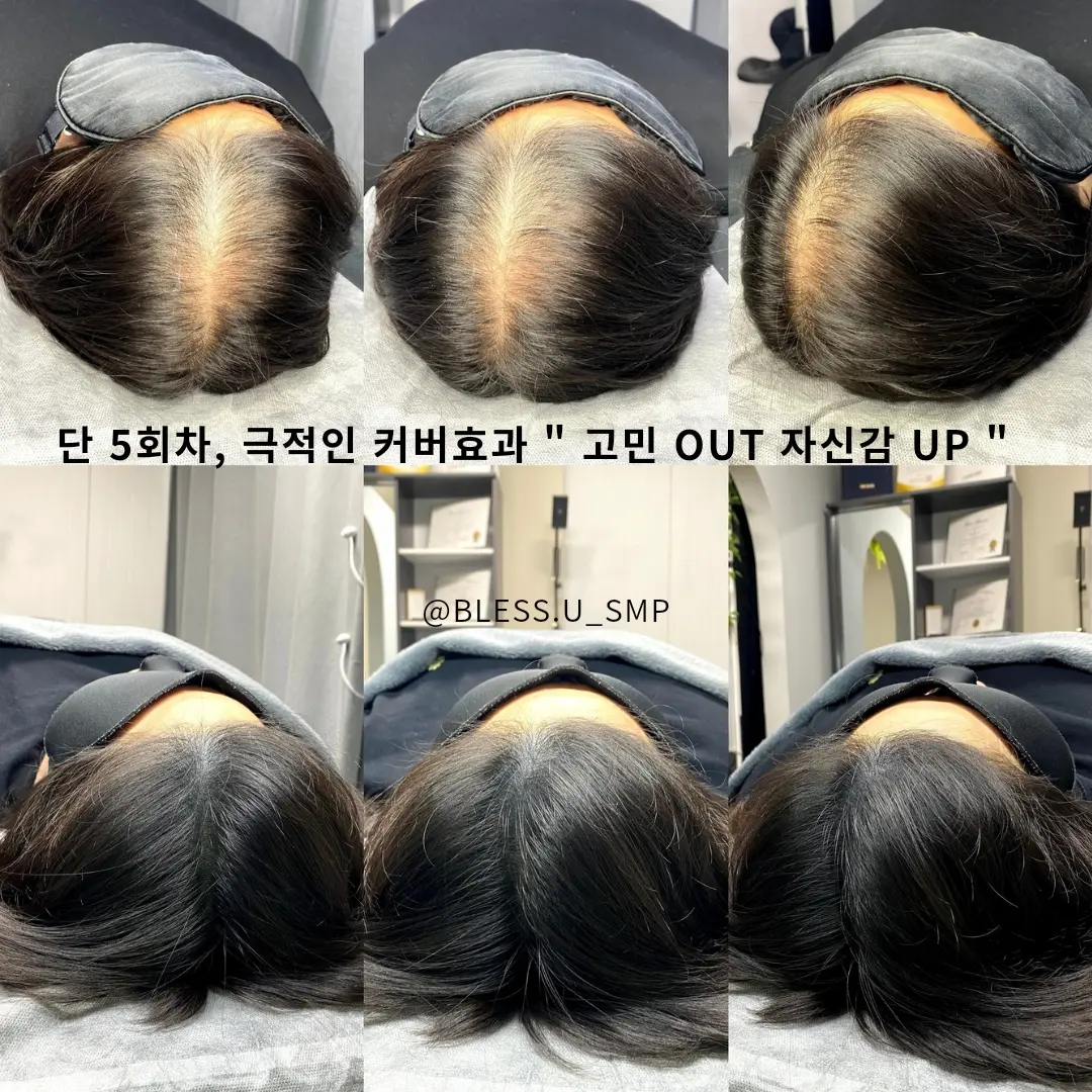 탈모관리 새로운 솔루션 두피문신SMP / 블래스유smp - 숨고, 숨은고수 탈모관리 새로운솔루션 두피문신SMP