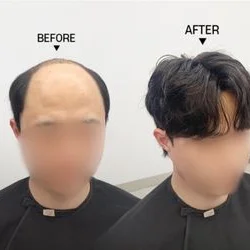 가발/붙임머리/ 증모/ 두피관리 /탈모펌
