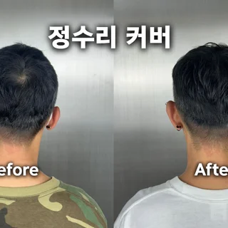 남성 탈모커버 전체 시술 3회차 작업완료 (3/3)