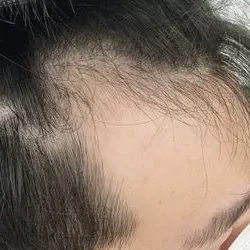 M자탈모관리
