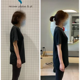 굽은 등 교정