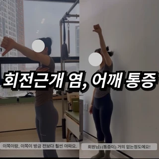 회전근개염, 어깨 통증 - 20대 수영 강사