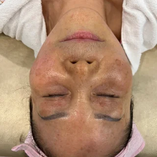 실크테라피 3회 후 피부톤 변화