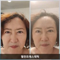 리프팅 얼굴경락관리 전후사진