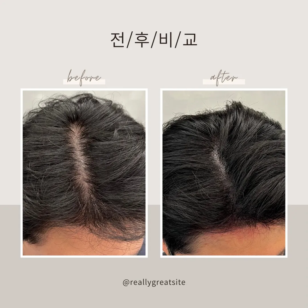 SMP 삭발, 숱채움,헤어라인교정 / 이창준 - 숨고, 숨은고수 SMP 삭발, 숱채움,헤어라인교정