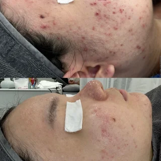 문제성피부.바디멜라닌케어