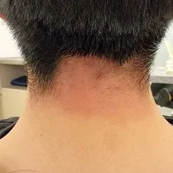 다발성원형탈모