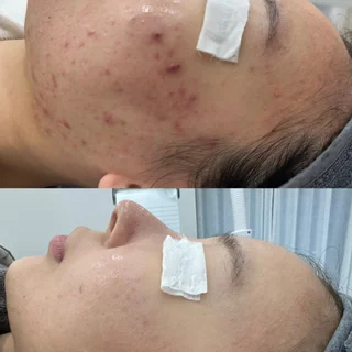 문제성피부.바디멜라닌케어