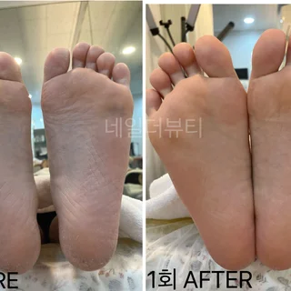 발각질